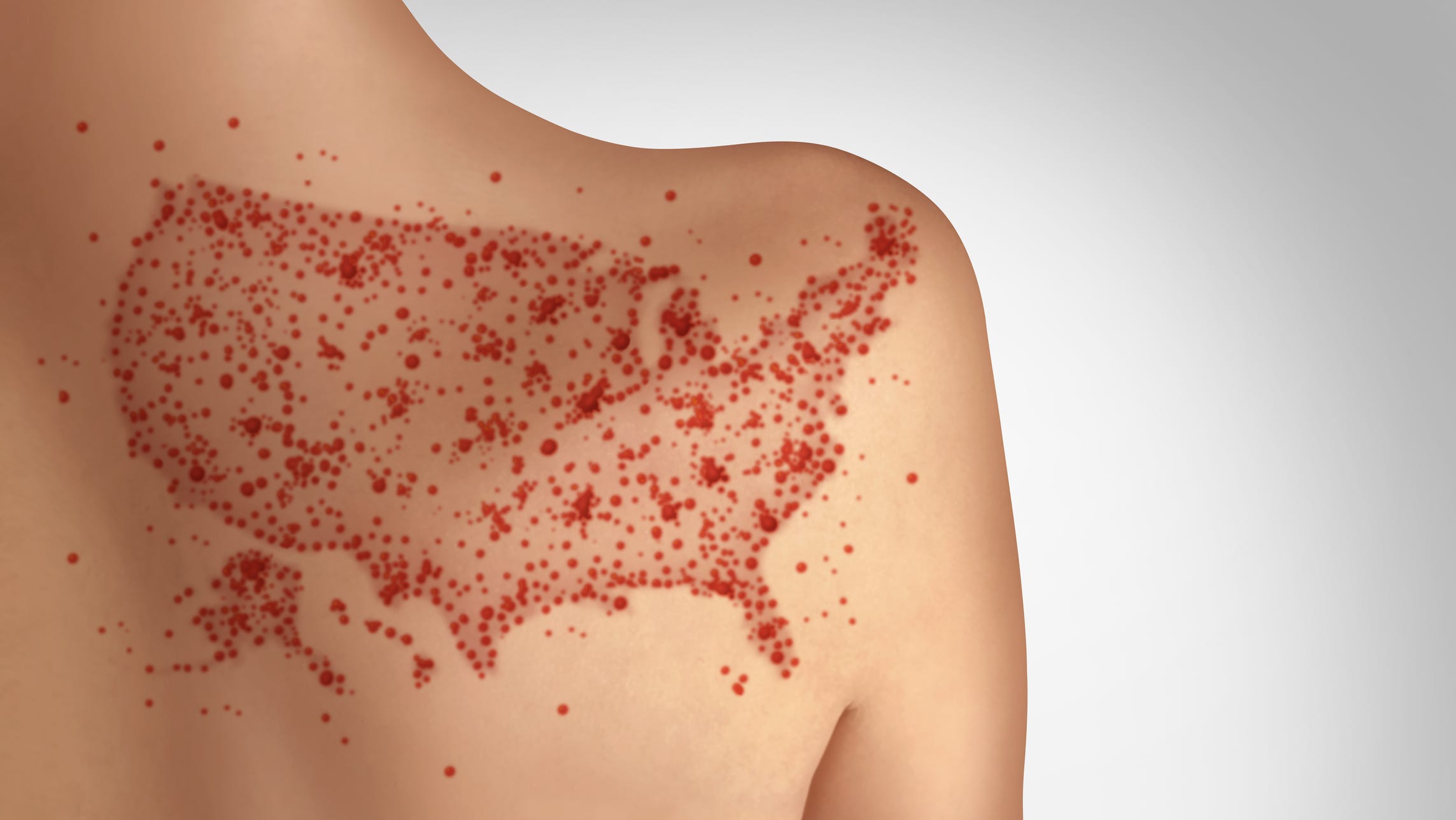 Current Status Of The Measles Outbreak Across The United States Current Status Of The Measles Outbreak Across The United States