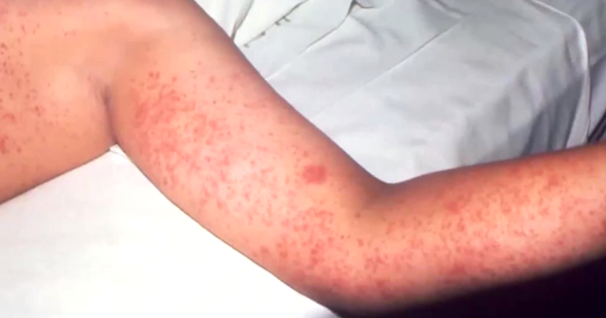 Kansas Faces A Measles Resurgence: Understanding The Causes And Prevention Kansas Faces A Measles Resurgence: Understanding The Causes And Prevention