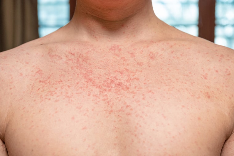 Measles Elimination In Canada: A Looming Threat Measles Elimination In Canada: A Looming Threat