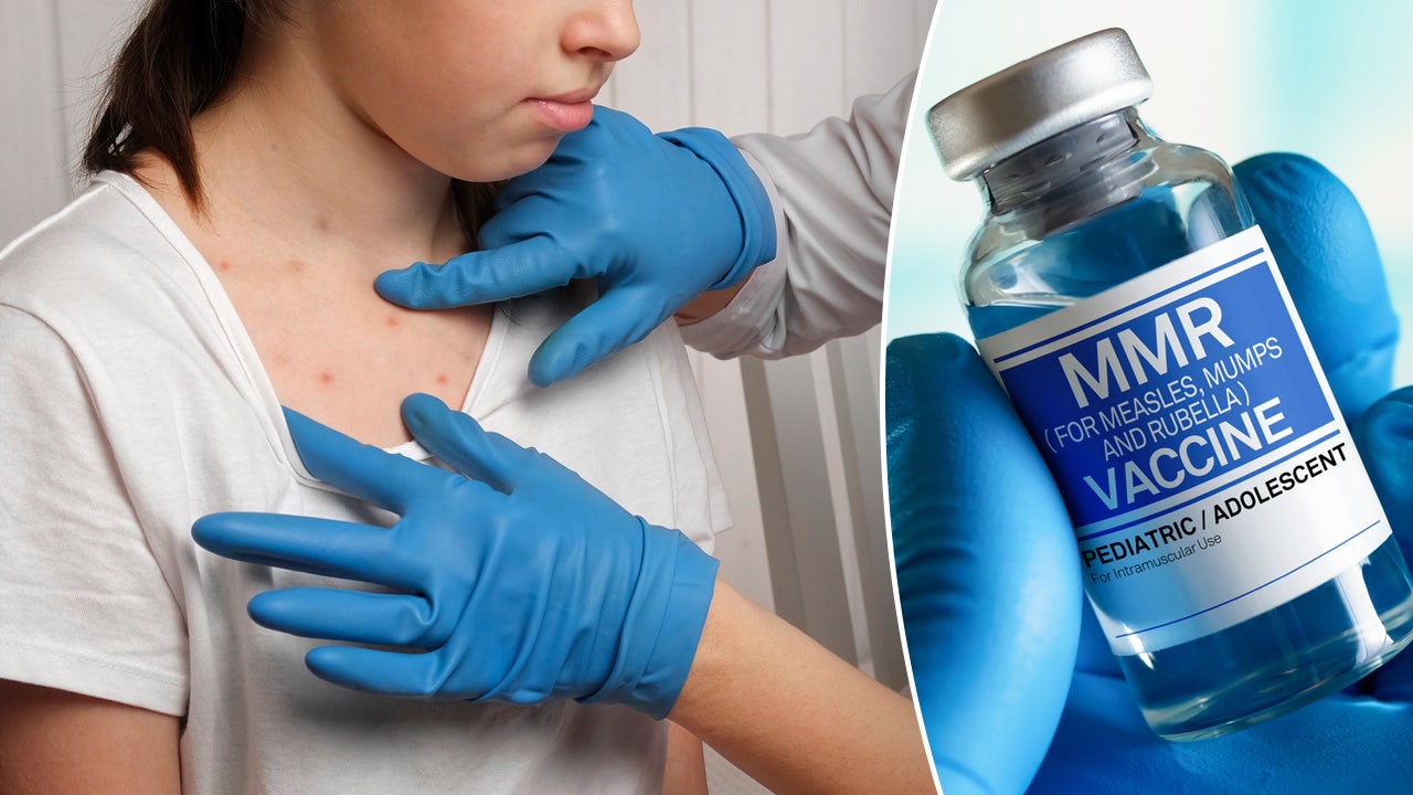 Measles Outbreak Prompts School Quarantine In North Dakota: Unvaccinated Children Affected Measles Outbreak Prompts School Quarantine In North Dakota: Unvaccinated Children Affected