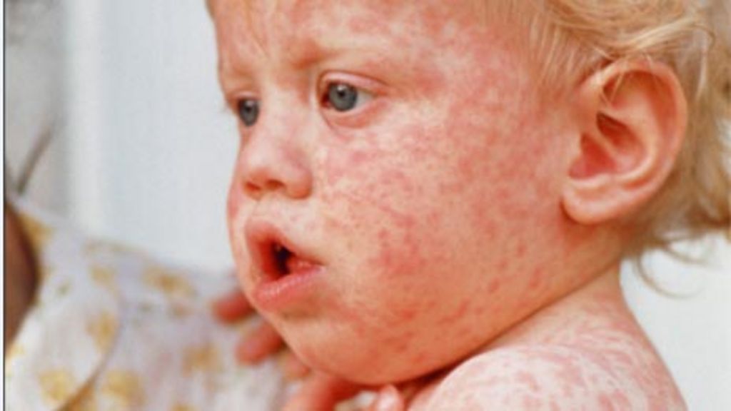 Recent Measles Cases In Texas: Tracking The Spread And Unrelated Clusters Recent Measles Cases In Texas: Tracking The Spread And Unrelated Clusters
