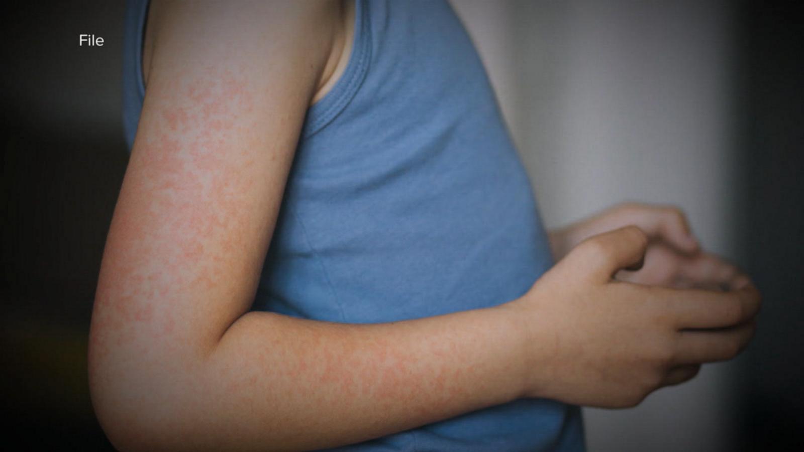 Texas Measles Outbreak: Impact On Israel Texas Measles Outbreak: Impact On Israel