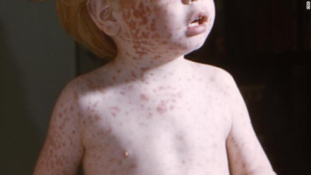The Rise Of Measles Cases In Kansas: Public Health Response And Prevention Strategies The Rise Of Measles Cases In Kansas: Public Health Response And Prevention Strategies