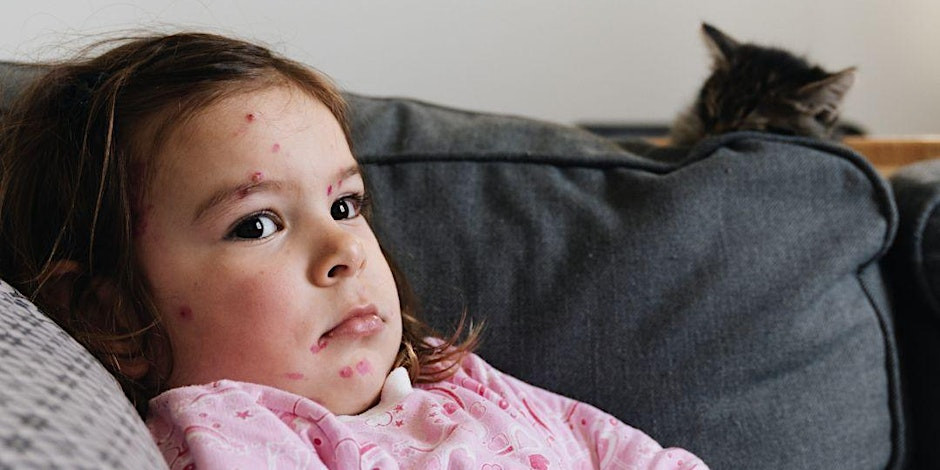US Measles Cases Rise To 1,046: Indiana Outbreak Concludes US Measles Cases Rise To 1,046: Indiana Outbreak Concludes
